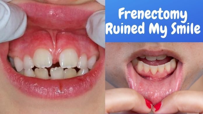 Frenectomy Ruined My Smile