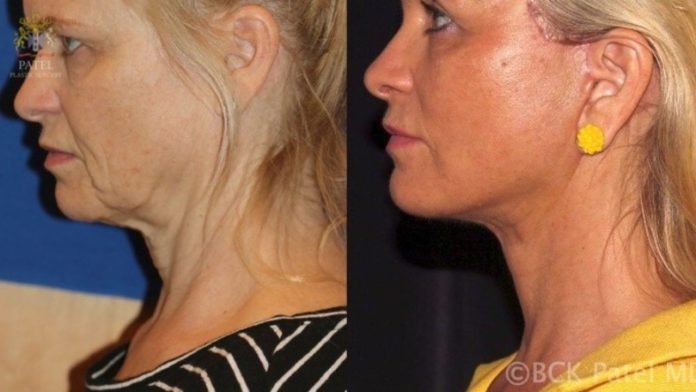 Best Age for a Deep Plane Facelift